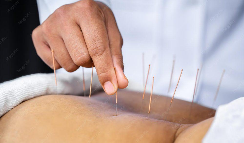 Dry Needling therapy at Carry Wellness
